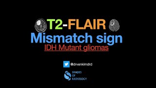 T2FLAIR Mismatch sign [upl. by Calvina]