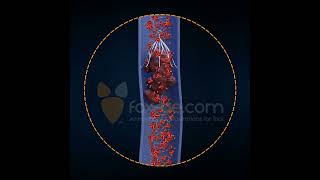 Inferior Vena Cava Filter [upl. by Kimmy]