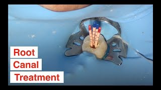 Root Canal Treatment [upl. by Wisnicki315]