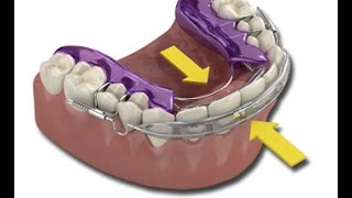 What is an Inman Aligner [upl. by Arinaid]