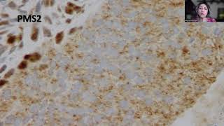 Tip42MMR Stains in Endometrial Carcinoma [upl. by Rraval132]