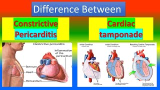 Difference Between Constrictive Pericarditis and Cardiac Tamponade [upl. by Finkelstein]