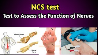 NCS Test  Nerve Conduction Study Procedure [upl. by Roger]