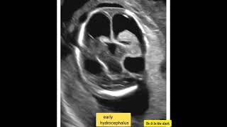 Early hydrocephalus radiology ultrasoundscans ultrasound radiography DoItInTheDark [upl. by Coady]