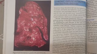 Bronchiectasis  SPECIAL PATHOLOGY [upl. by Portuna784]