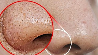 how to remove blackheads from nose and chin area naturally and permanently  DIY blackhead removal [upl. by Catie]