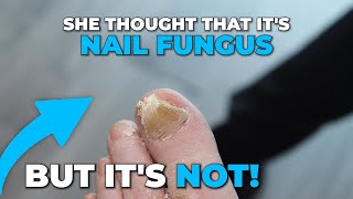 IF ITS NOT A NAIL FUNGUS THEN WHAT IS IT [upl. by Ylrebmek]