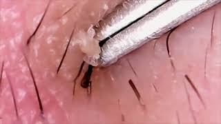 INGROWN HAIR Removal 😲 Infected Ingrown Hairs [upl. by Milzie]