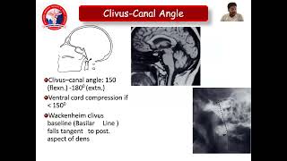 Imaging of The Craniovertebral Junction  Dr J Viyango Pandian [upl. by Ilrac]