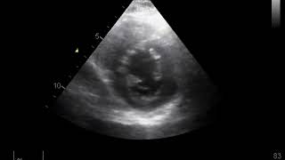 Left Atrial Myxoma  Echo [upl. by Asli]