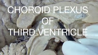 CHOROID PLEXUS OF THIRD VENTRICLE  An educational video [upl. by Elac]