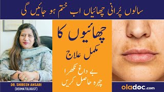 GET RID OF PIGMENTATION  Chaiyan Khatam Karne Ka Tarika  Melasma Aur Pigmentation Ka Ilaj [upl. by Aleemaj]