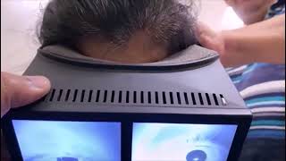 Multicanal BPPV with Canal Switch and Jam [upl. by Chang]