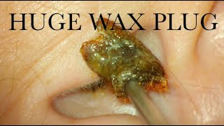 HUGE WAX PLUG  COLACE TO THE RESCUE  4KHD [upl. by Smitt173]