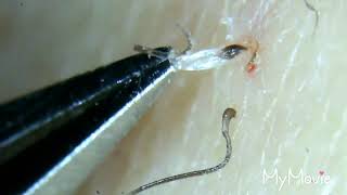 Satisfying Plucking and Slimy Ingrown Hair Roots [upl. by Notluf]