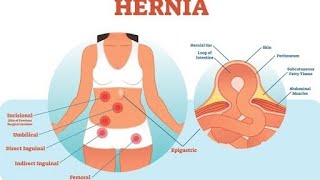 HERNIAKILLA hernias hérniadiscal herniadiscal mjekesi medicina kirurgjiabdominaleshendeti [upl. by Alanson809]