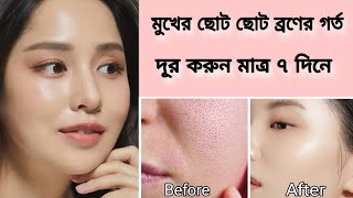 Home remedy to remove acne scars on face Natural ways to remove pimples scars on faceRemove pits [upl. by Ahsilem]