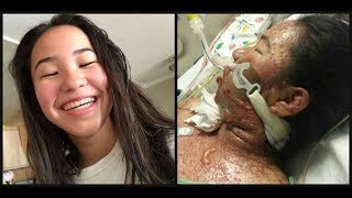 LA teenager’s skin melts’ off in severe reaction to prescription medication with strict FDA warning [upl. by Kalvin864]