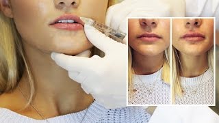 Lip Filler Experience  Start to Finish with 1 Syringe of Juvederm [upl. by Ardnikat]