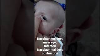 Nasolacrimal duct massageinfected Nasolacrimal duct obstruction Dr Hunar Jamal [upl. by Yatnod]