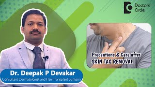 SKIN CARE After LASER SKIN TAG REMOVAL  Radiofrequency Laser  Dr Deepak P DevakarDoctors Circle [upl. by Matthia]