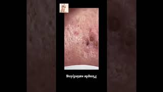 Blackheads Removal  Acne Treatment and Very Satisfying Satisfying Pimple pop blackheads [upl. by Lacey128]