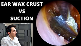 Encrusted Ear Wax VS Suction [upl. by Cyma]