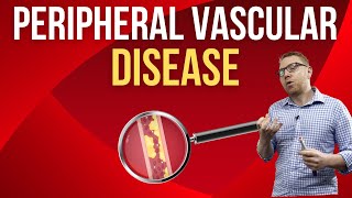 Peripheral Vascular Disease [upl. by Uon]