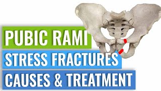 Pubic Ramus Stress Fractures Treatment [upl. by Orly]