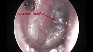 ACUTE SUPPURATIVE OTITIS MEDIA  ASOM   Stage of Suppuration on Otoendoscopy [upl. by Ahsile685]