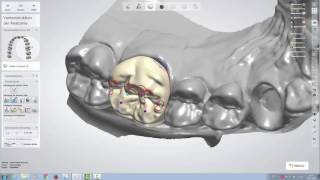 Design einer vollanatomischen okklusal verschraubten Krone mit dem 3Shape Dental Designer 1610 [upl. by Corabel184]