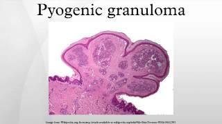 Pyogenic granuloma [upl. by Chad803]