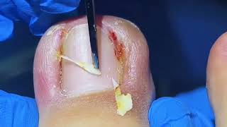 Satisfying Ingrown Toenail Removal [upl. by Milly593]