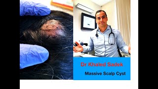 Massive Scalp Cyst LipomaCystcom Dr Khaled Sadek [upl. by Markus]