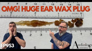 OMG HUGE EAR WAX PLUG REMOVED  EP953 [upl. by Pelson]