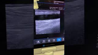 Ultrasound evaluation of a hematoma [upl. by Ellora169]