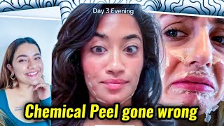 INFLUENCERS NEED TO STOP PROMITING CHEMICAL PEEL AS BEAUTY TREATMENT [upl. by Saixela995]