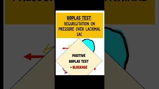 ROPLAS TEST dacryocystitis opthalmology [upl. by Saks497]