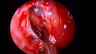 Right maxillary sinus empyema unedited uncinectomy middle meatal antrostomy under local [upl. by Ursulette]