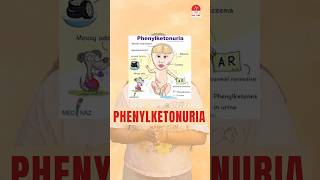 Phenylketonuria by Ms Mithlesh  Norcet 70 amp 80  BSc Undergraduate  Nurisng naext Live  NNL ONE [upl. by Rianon]