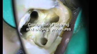 PeriodontalEndodontic considerations [upl. by Halyk302]