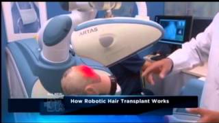 Robotic Hair Transplant Surgery  ARTAS Hair Restoration [upl. by Halika]