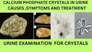 CALCIUM PHOSPHATE CRYSTALS IN URINECAUSES SYMPTOMS TREATMENT OF CALCIUM PHOSPHATE STONES [upl. by Golliner]