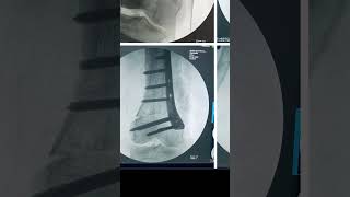 Can knock knees be corrected with surgery DFO distal femoral Osteotomy [upl. by Oderfla]