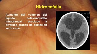 Hidrocefalia I [upl. by Fleischer]