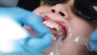 Braces Putting Braces On Bonding Procedure  Aura Orthodontics [upl. by Ahsotal951]