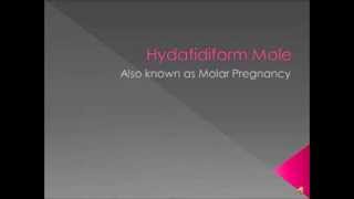 Hydatidiform Mole Video [upl. by Jeni604]