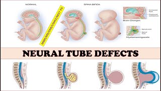 NeuraltubedefectsspinabifidameningomyelocelemeningoceleAnencephalyEncephalocele [upl. by Nave230]