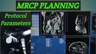 MRCP PLANNING step by step MRCP planning or protocol Mrcp planning GE machine [upl. by Niwle641]