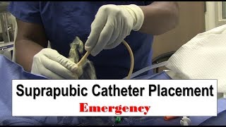 Emergency Suprapubic Catheter Placement [upl. by Gretal]